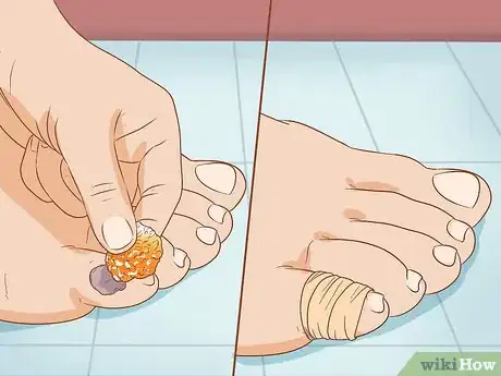 Imagen titulada Treat a Blood Blister Step 11