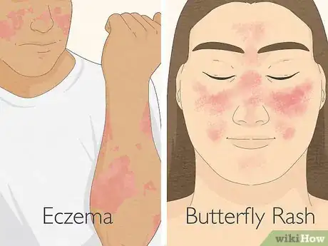Imagen titulada Tell Eczema from Butterfly Rash Step 1