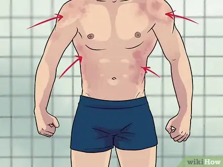 Imagen titulada Recognize Epstein Barr Symptoms Step 7