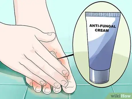 Imagen titulada Get Rid of Foot Fungus Step 2