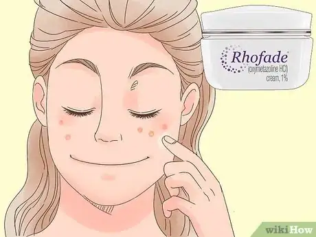 Imagen titulada Remove the Redness of a Pimple Step 11