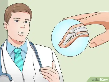 Imagen titulada Splint Trigger Finger Step 13