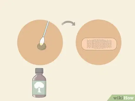 Imagen titulada Get Rid of Warts Step 15