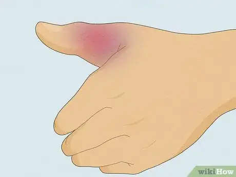 Imagen titulada Wrap a Sprained Thumb Step 18