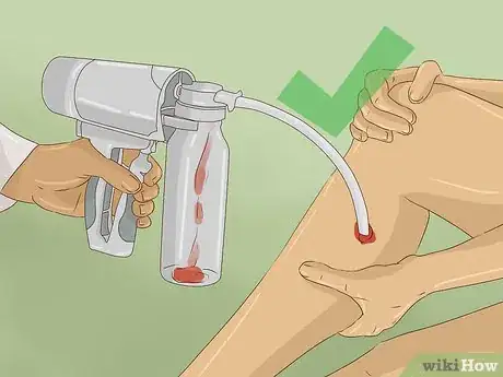 Imagen titulada Treat a Rattlesnake Bite Step 7