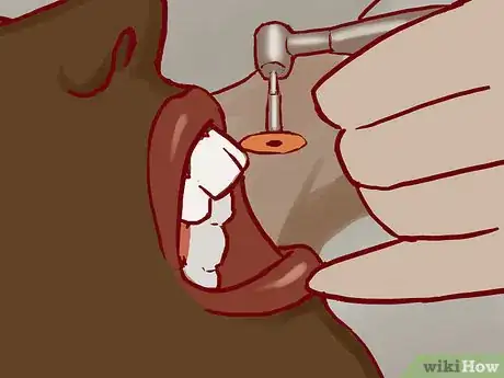 Imagen titulada Treat a Broken Tooth Step 11