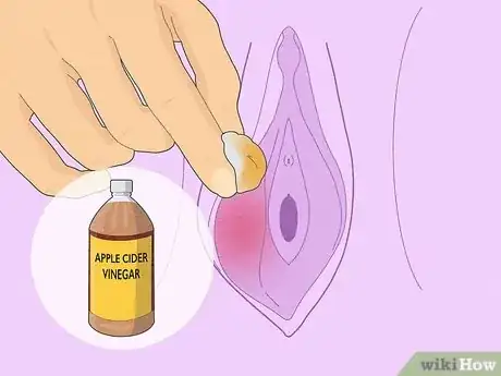 Imagen titulada Treat Vaginal Cysts Step 7