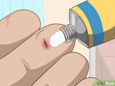 Imagen titulada Remove a Deep Splinter Step 8