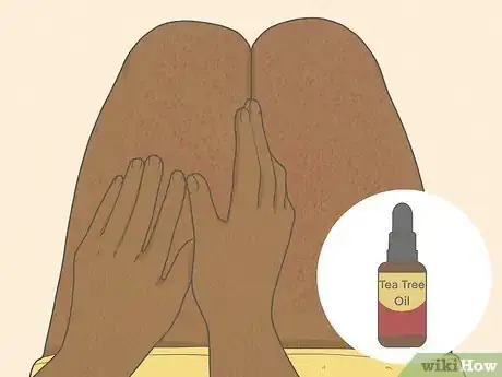 Imagen titulada Get Rid of Razor Burn Fast Step 10