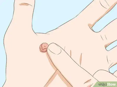 Imagen titulada Identify Warts Step 5