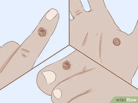 Imagen titulada Identify Warts Step 6