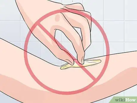 Imagen titulada Remove Keloid Scars at Home Step 3