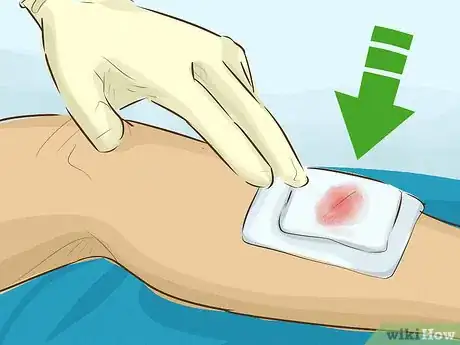 Imagen titulada Stop Bleeding Step 19