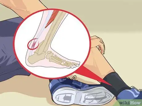 Imagen titulada Treat Tendonitis Step 1