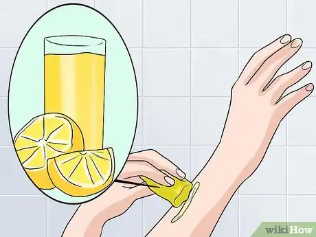 Imagen titulada Remove Keloid Scars at Home Step 5