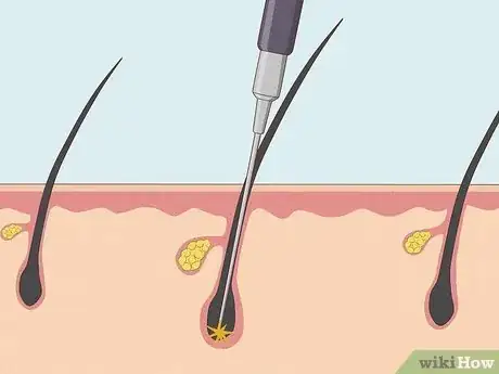 Imagen titulada Remove Pubic Hair Permanently Step 1