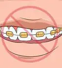 elegir el color de los brackets