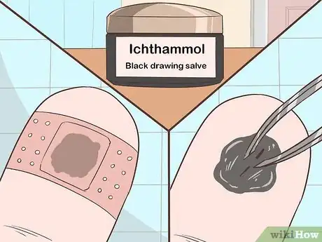 Imagen titulada Remove a Deep Splinter Step 4
