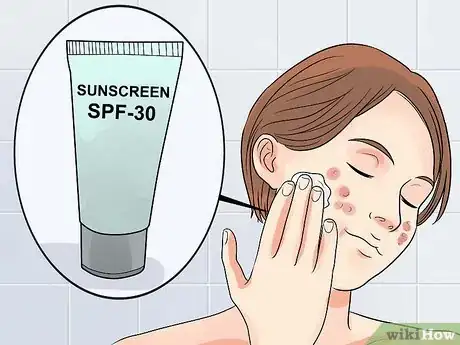 Imagen titulada Get Rid of Acne if You Have Fair Skin Step 15