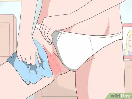 Imagen titulada Treat Jock Itch With Sudocrem Step 3
