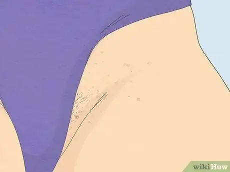 Imagen titulada Get Rid of Fordyce Spots Step 12