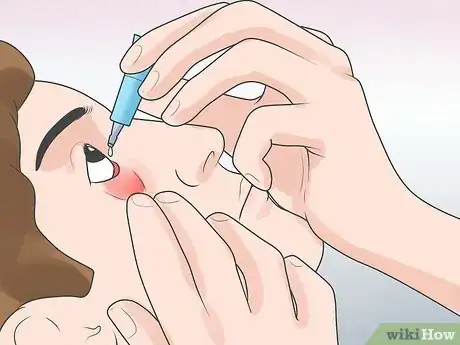 Imagen titulada Recognize an Eyelid Cyst Step 5