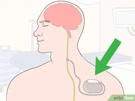 Imagen titulada Stimulate the Vagus Nerve Step 10