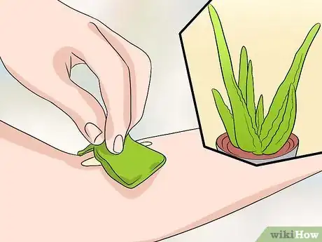 Imagen titulada Remove Keloid Scars at Home Step 7
