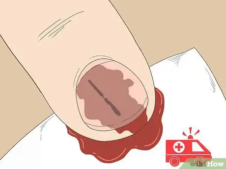 Imagen titulada Remove a Splinter Under Your Fingernail Step 1