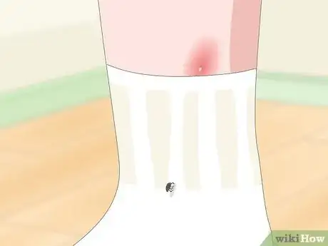 Imagen titulada Detect Flea Bites Step 5