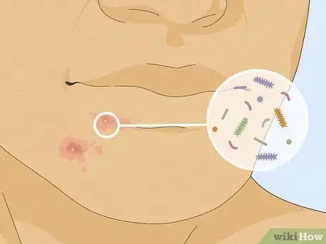 Imagen titulada Heal Raw Skin Step 11