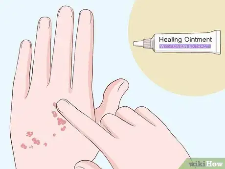 Imagen titulada Heal Scabies Scars Step 2