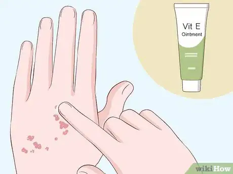 Imagen titulada Heal Scabies Scars Step 5
