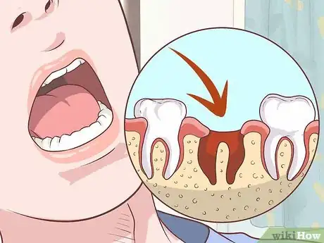 Imagen titulada Prepare for Tooth Extraction Step 17