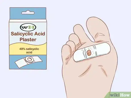 Imagen titulada Identify Warts Step 9