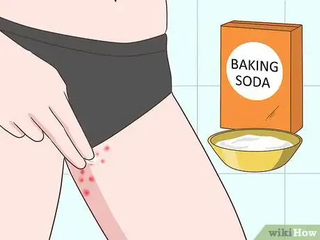 Imagen titulada Treat Chigger Bites Step 7