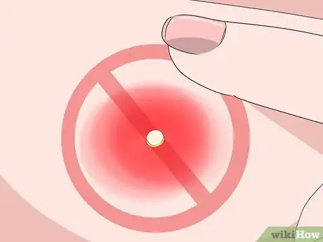 Imagen titulada Remove Pus from a Wound Step 11