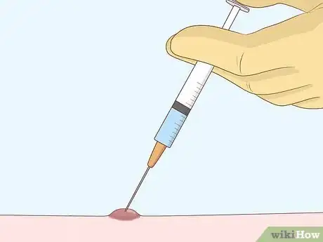 Imagen titulada Heal Scabies Scars Step 8