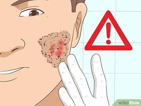 Imagen titulada Remove an Ingrown Hair Step 5