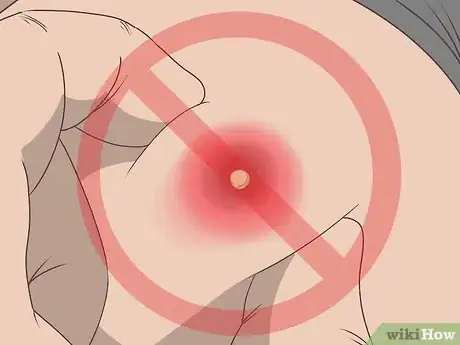 Imagen titulada Remove Pus from a Wound Step 10