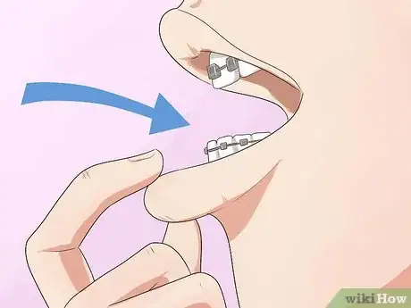 Imagen titulada Make Your Braces Hurt Less Step 14