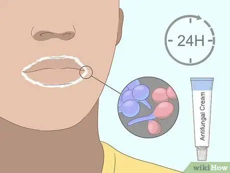 Imagen titulada Cure Angular Cheilitis Step 9