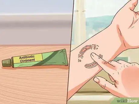 Imagen titulada Treat a Human Bite Step 5