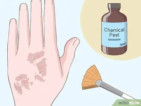 Imagen titulada Heal Scabies Scars Step 9