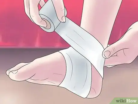 Imagen titulada Treat a Broken Ankle Step 10