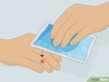 Imagen titulada Deal With the Pain of a Door Being Shut on Your Finger Step 6