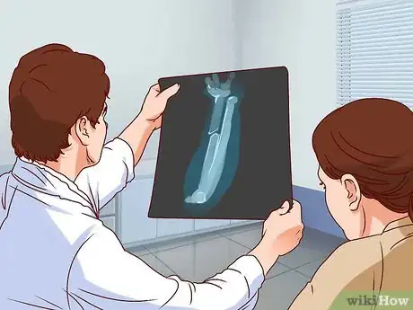 Imagen titulada Apply a Cast to a Broken Arm Step 4