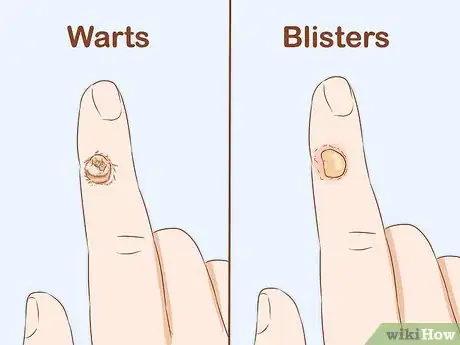 Imagen titulada Identify Warts Step 3