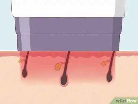 Imagen titulada Remove Pubic Hair Permanently Step 2