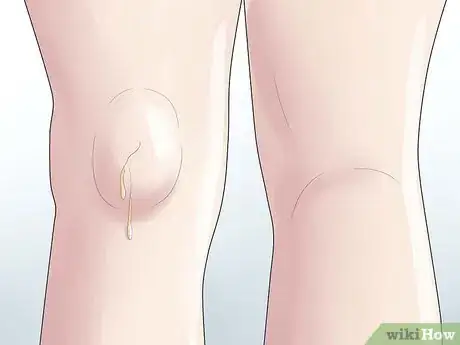 Imagen titulada Know if You Have a Baker's Cyst Step 6